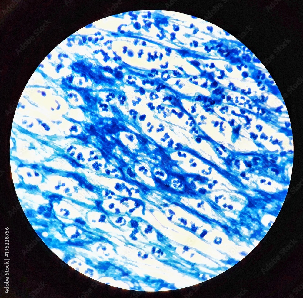 Smear of Acid-Fast bacilli (AFB) stained from sputum specimen with ...