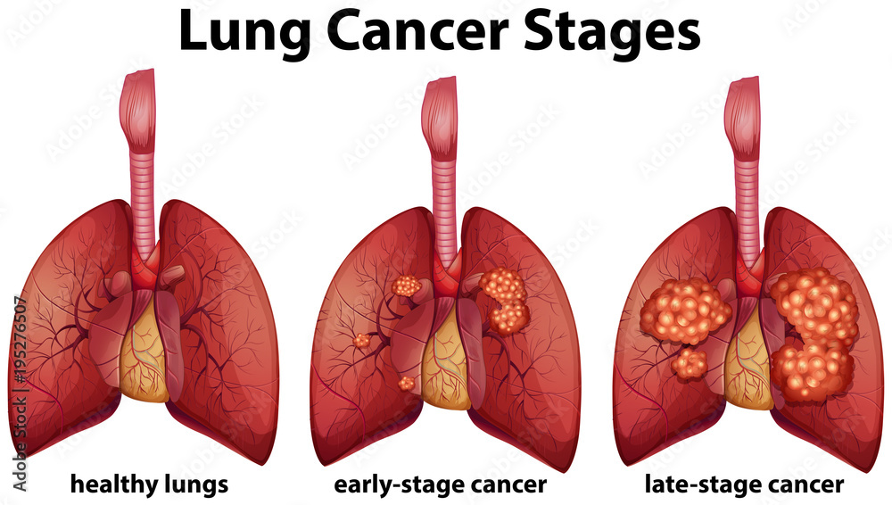 Diagram Showing Lung Cancer Stages Vector De Stock Adobe Stock