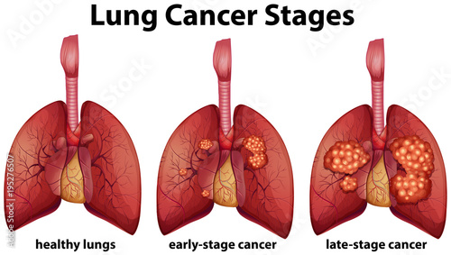 Diagram showing lung cancer stages