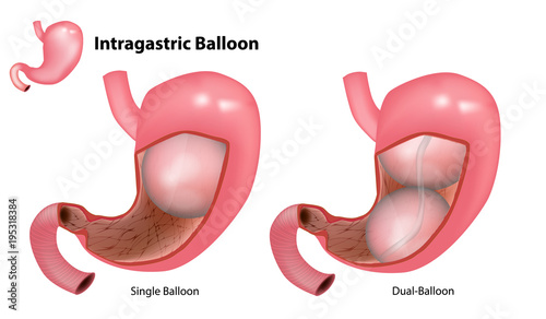 Two types Intragastric Balloon: Dual-Balloon and Single Balloon. Gastric Balloon Inside a Stomach. 