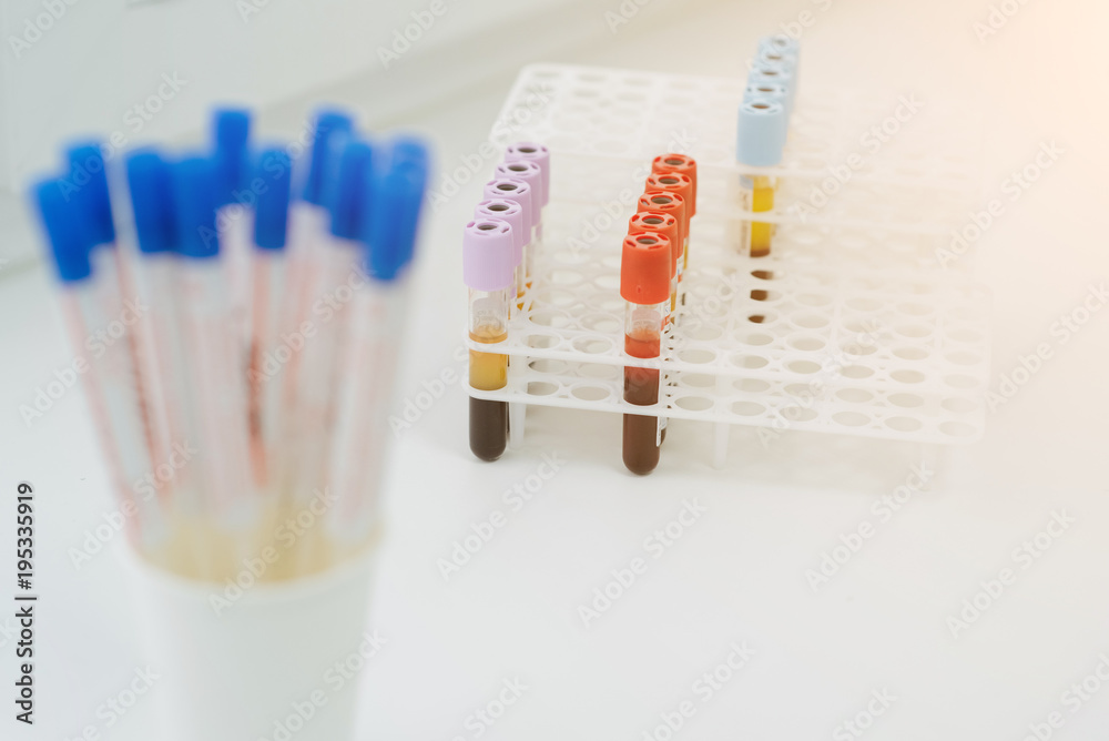 Medical equipment. Test tubes of centrifuge machine with blood and plasma in hematology laboratory. Scientist. Genetic. Pro-coagulation Clot Activator blood collection tube, with red plastic stopper Medical equipment. Test tubes of centrifuge machine with blood and plasma in hematology laboratory. Scientist. Genetic. Pro-coagulation Clot Activator blood collection tube, with red plastic stopper