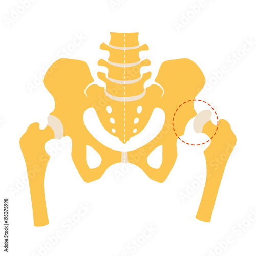 Hip dysplasia, flat design. Vector illustration, Isolated on white background. photo