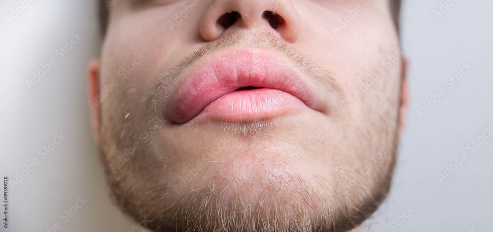 allergy on the lip. Angioedema.