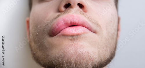 allergy on the lip. Angioedema. photo