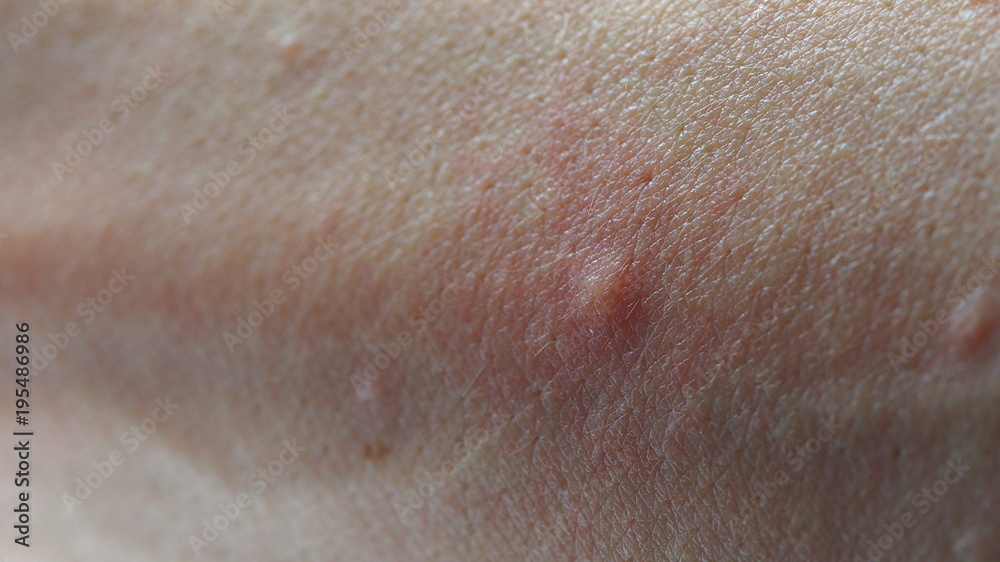 Fototapeta premium Macro image of symptoms of itchy urticaria or rash