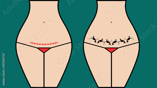 Masking cesarea scar section tattoo
