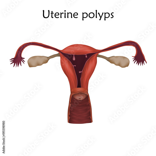 Uterine polyps. Human realistic uterus. Anatomy illustration. Colored image, white background. Gynecological diseases.