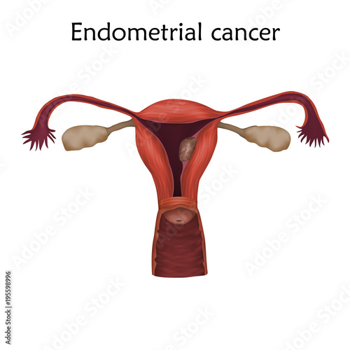 Endometrial cancer. Human realistic uterus. Anatomy illustration. Colored image, white background. Gynecological diseases.