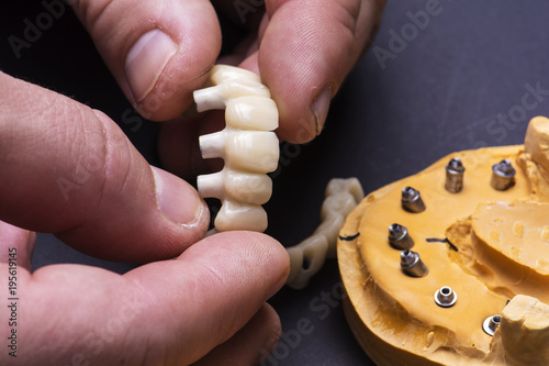 Creating temporary crowns on implants