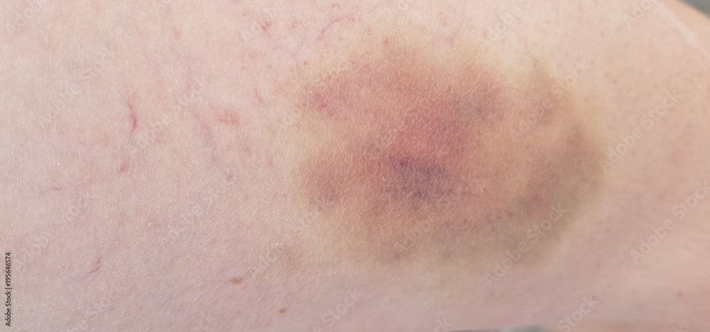 Fototapeta premium hématôme sur la peau,contusion