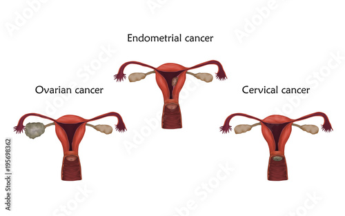 Ovarian, endometrial and cervical cancer. Human realistic uterus. Anatomy illustration. Colored image, white background. Gynecological diseases.