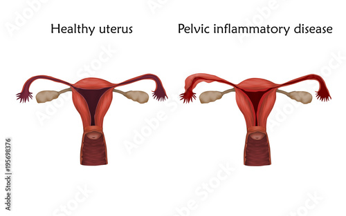 Pelvic inflammatory disease and healthy uterus. Human realistic uterus. Anatomy illustration. Colored image, white background. Gynecological diseases.