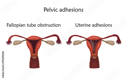 Pelvic adhersions. Uterine adhesions and fallopian tube obstruction. Human realistic uterus. Anatomy illustration. Colored image, white background. Gynecological diseases..