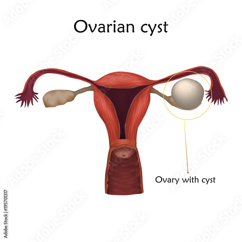 Ovarian cyst. Human realistic uterus. Anatomy illustration with specification. Colored image, white background. Gynecological diseases.