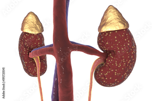 Pyelonephritis, medical concept, 3D illustration showing presence of purulent blisters in kidney tissue photo