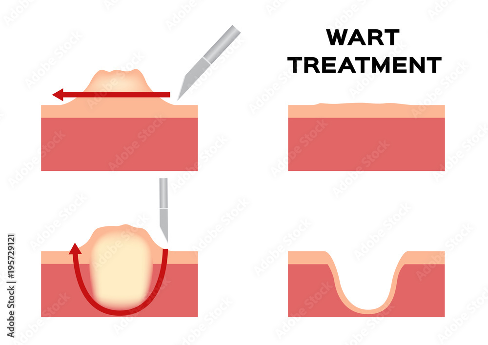 wart treatment . remove it from skin by surgery vector callus Stock