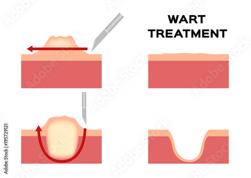 wart treatment . remove it from skin by surgery vector callus