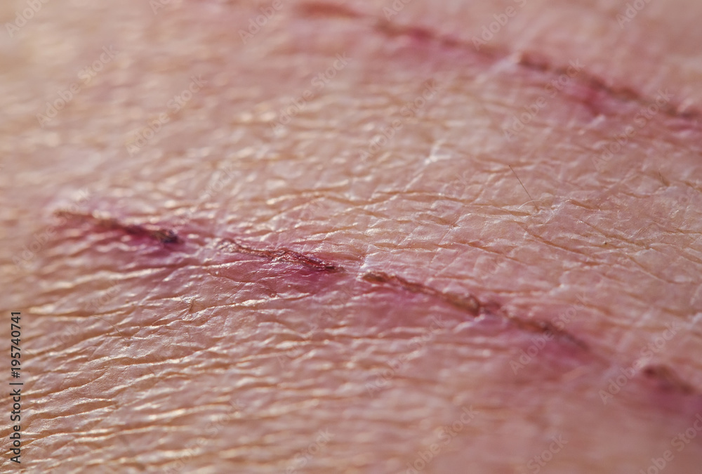 Scratches On Skin