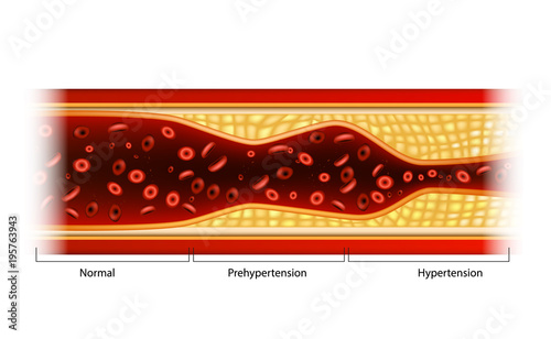 Hypertension and Prehypertension. Plaque in blood vessels