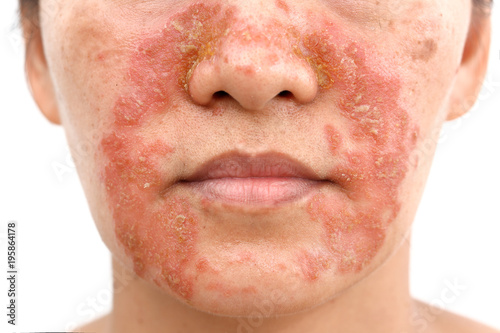 Seborrheic Dermatitis face photo