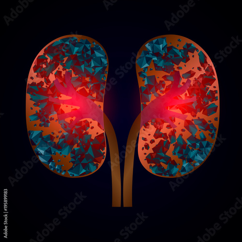  Nephrolithiasis kidney stones disease. Vector medical illustration isolated