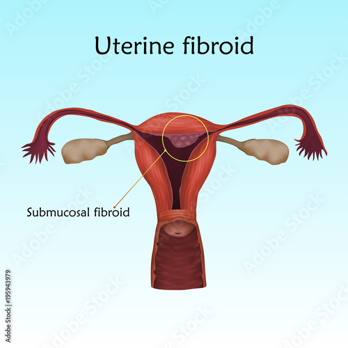 Uterine fibroid. Human realistic uterus. Anatomy illustration with specification. Colored image, blue background. Gynecological diseases.