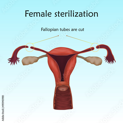 Sterilization. Human realistic uterus. Anatomy illustration with specification. Colored image, blue background. Gynecological diseases.
