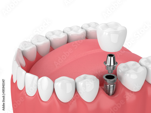 Fototapeta Naklejka Na Ścianę i Meble -  3d render of jaw with teeth and dental molar implant