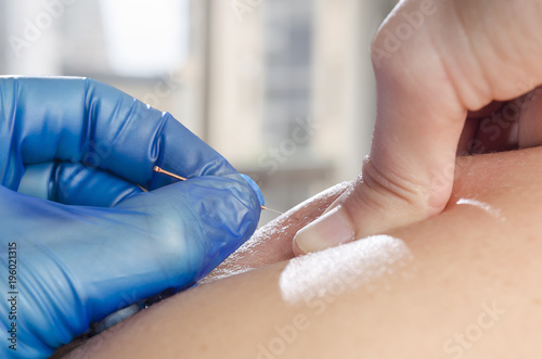 Needle and hands of physiotherapist doing a dry needling