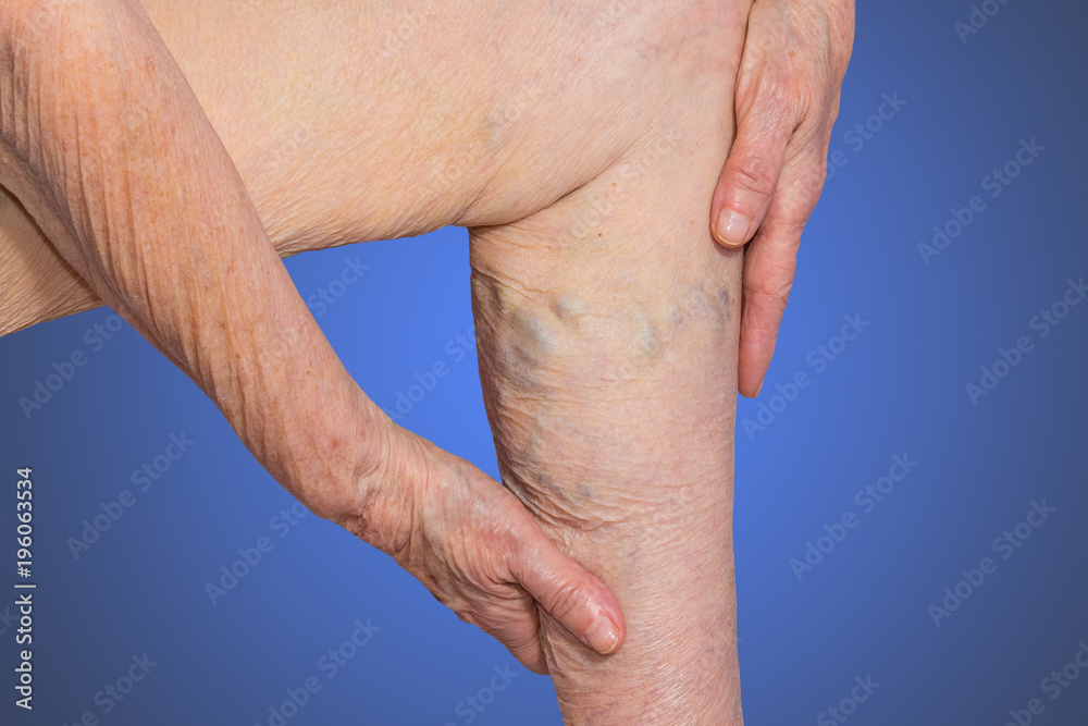 Fototapeta premium The varicose veins on a legs of old woman on blue