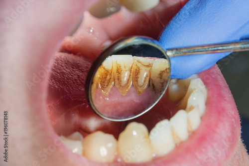 Dental treatment in dental clinic. Rotten carious tooth macro. Treatment endodontic canals