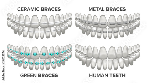 Braces Set Vector. Different Types. Human Jaw. Metal, Ceramic, Child. 3D Realistic Isolated Illustration