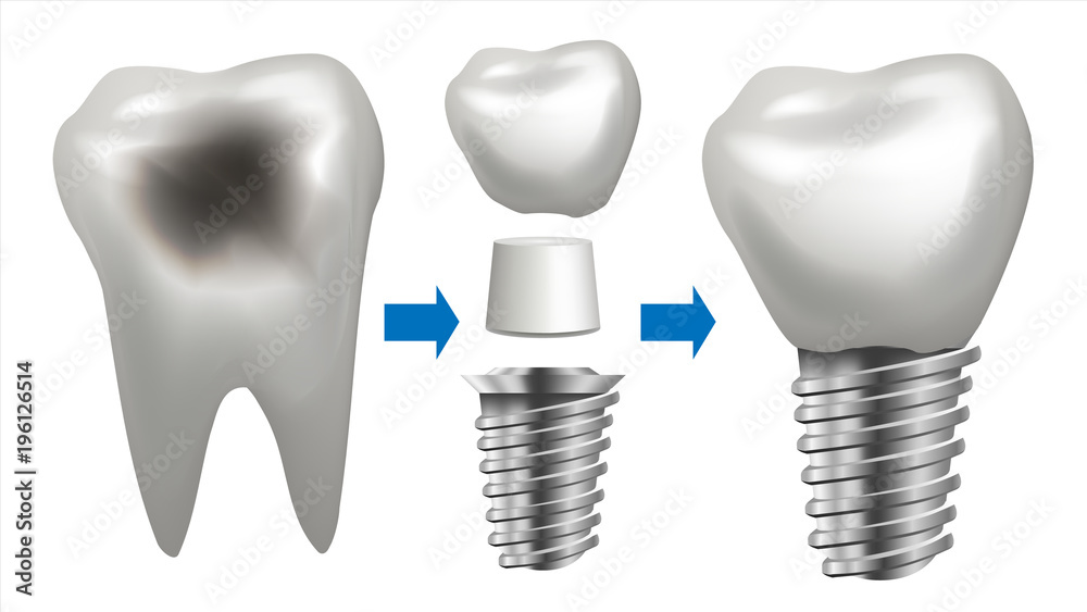 Dental Implant Vector. Tooth With Caries. Health Tooth Implant. Dental Clinic Stomatology Flyer. Realistic Isolated Illustration Dental Implant Vector. Tooth With Caries. Health Tooth Implant. Dental Clinic Stomatology Flyer. Realistic Isolated Illustration