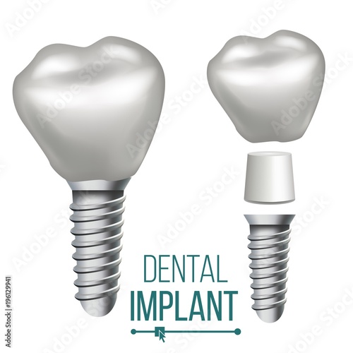 Dental Implant Vector. Medical Poster, Banner Design Element. Stomatology Dentist Advertisement. Realistic Isolated Illustration