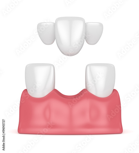 3d render of teeth with dental maryland bridge