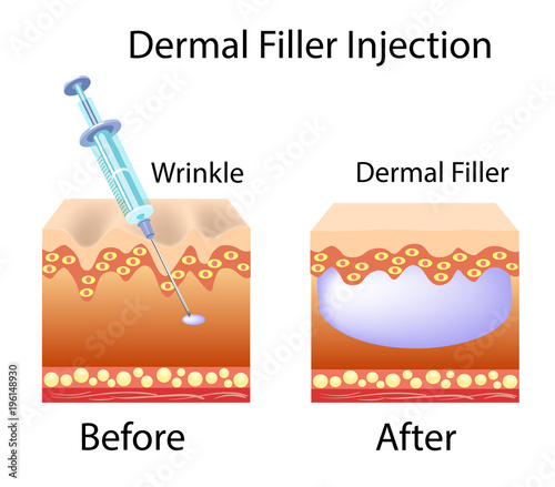 Vector illustration with cosmetic filler or Dermal fillers