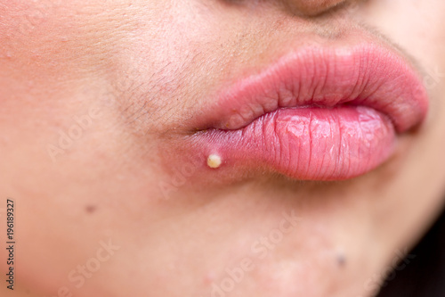 Close-up of acne on the skin, Acne on the lips.