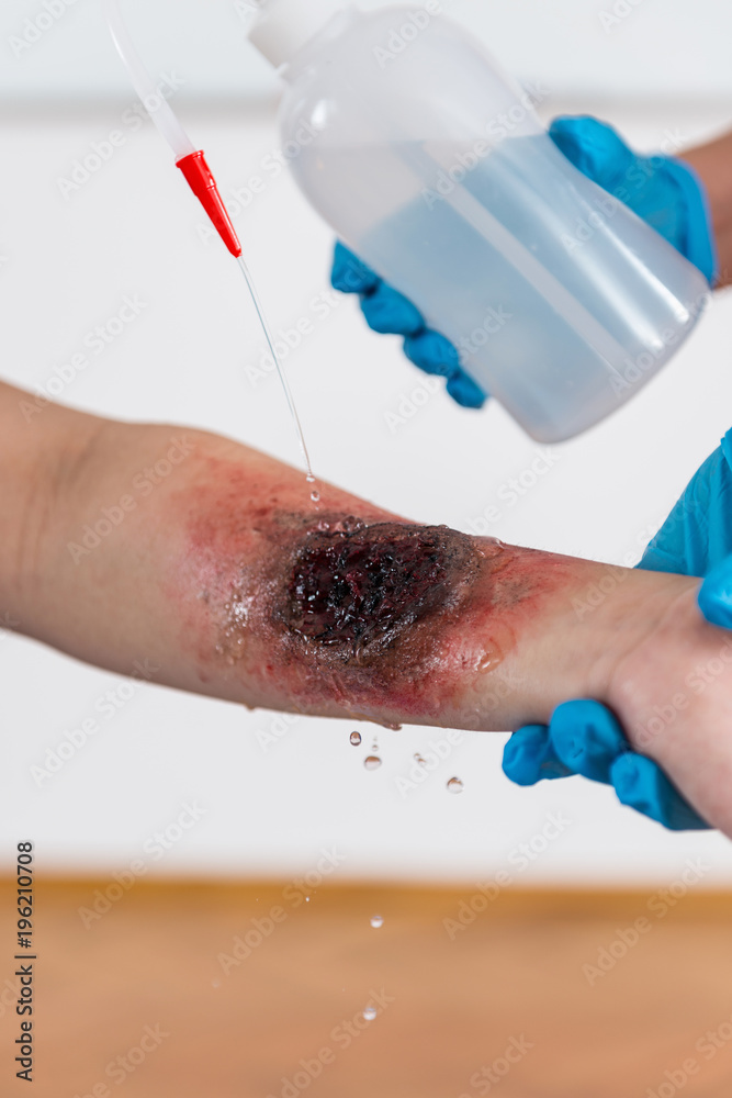 Fototapeta premium First Aid Training - Burn injury