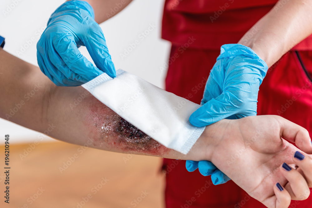 First Aid Training - Burn injury First Aid Training - Burn injury