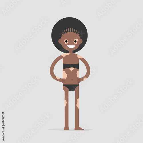 Vitiligo. Beautiful African american model wearing a swimsuit and demonstrating the white spots on her skin. Flat editable vector illustration, clip art