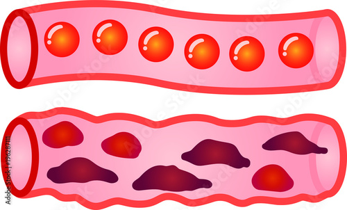 Healthy blood vessel and Unhealthy blood vessel 1