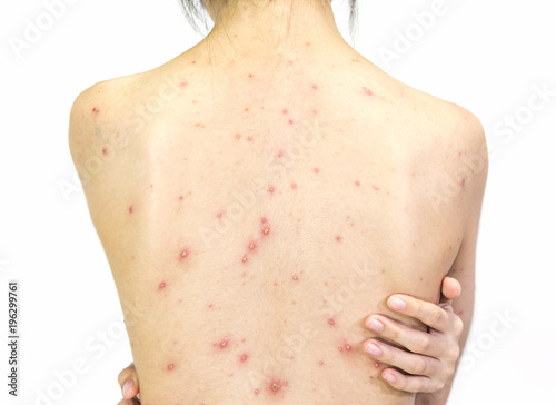 Closeup of girl back of Varicella virus or Chicken Pox on white background.