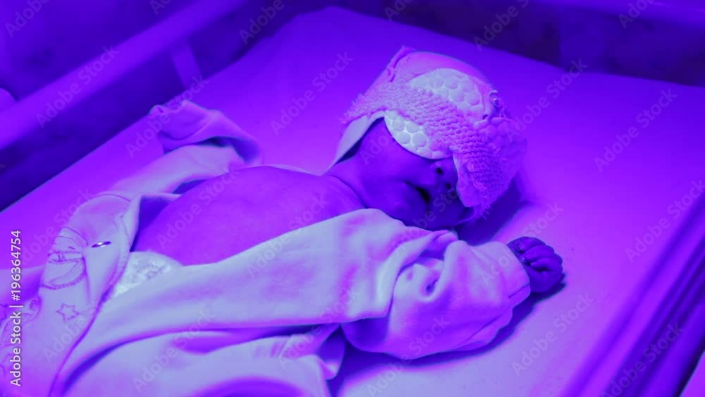 A baby newborn with elevated bilirubin lies under a blue lamp, phototherapy A baby newborn with elevated bilirubin lies under a blue lamp, phototherapy
