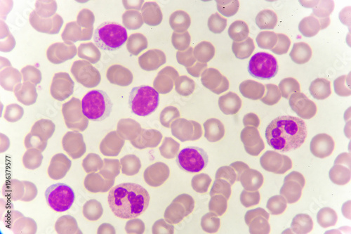 White blood cells in blood smear  analyze by microscope  