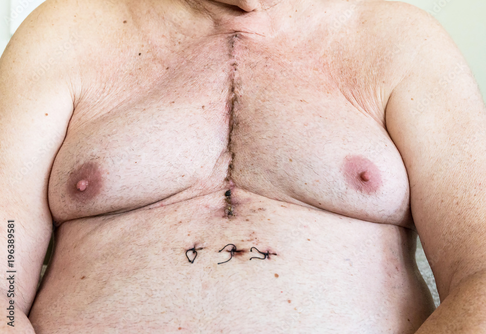 Naklejka premium Surgical scar from cardiac surgery of coronary artery disease