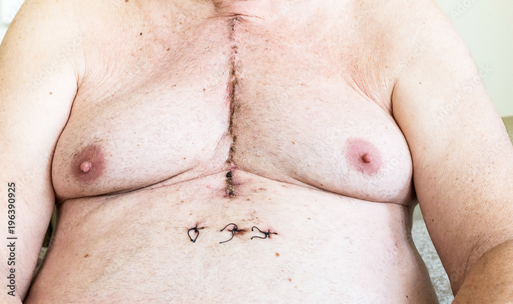 Surgical scar from cardiac surgery of coronary artery disease Surgical scar from cardiac surgery of coronary artery disease