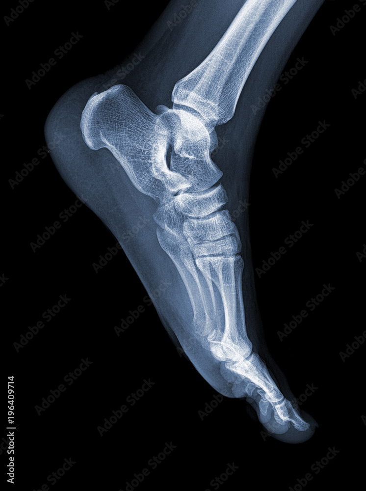 Deformed feet - pes planus Stock Photo | Adobe Stock