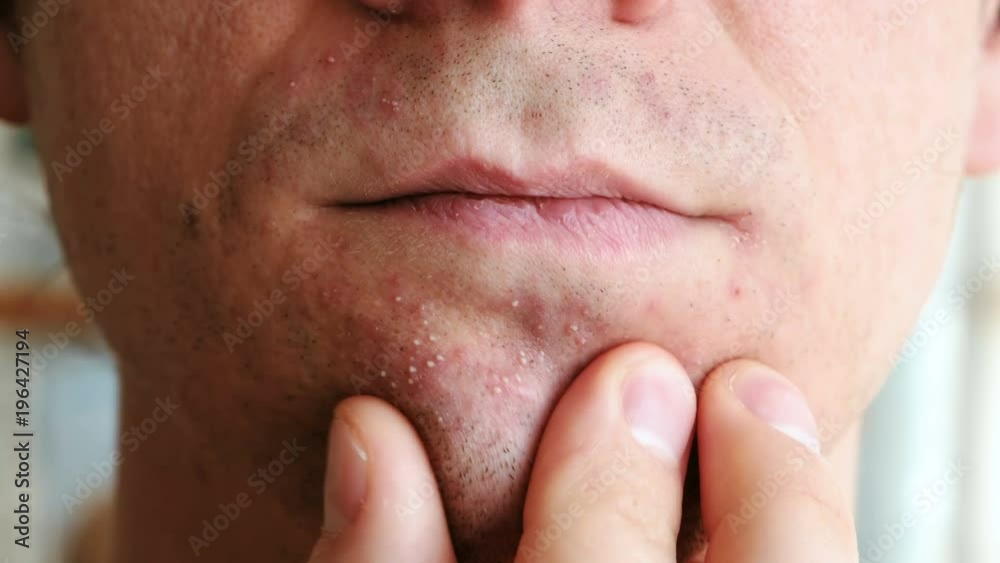 Skin Irritation After Shaving Mans Hands Squeeze Pimples On The Chin