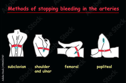 methods of stopping bleeding in the arteries white body on black background .  Education vector info graphic