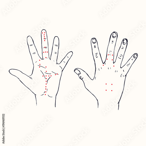 Hands  palm of left hand and dorsum of right hand  Korean acupuncture scheme with red points  hand drawn doodle  sketch in pop art style  black and white medical vector illustration